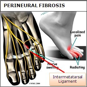 Corticosteroid injection feet