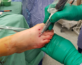 Minimally Invasive Foot Surgery (Key Hole)