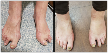 Revision Of Failed Foot Surgery
