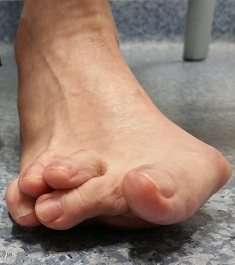 Revision Of Failed Foot Surgery