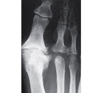 足の親指の関節の痛み
