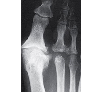 Big Toe Joint Pain