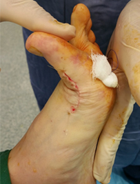 足の親指の関節の痛み