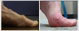 Big Toe Joint Pain