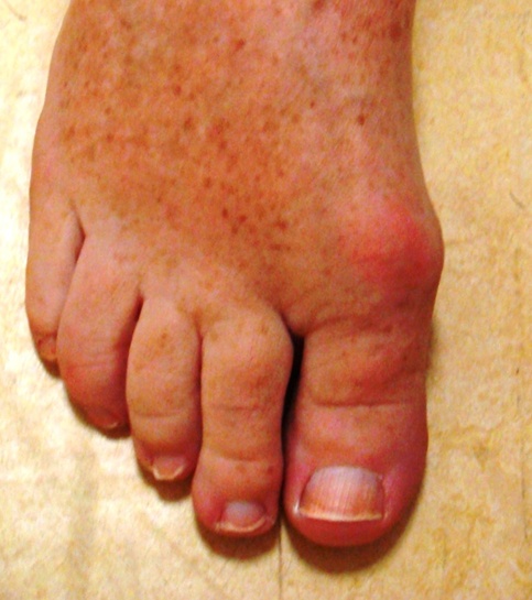 Big Toe Joint Pain