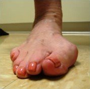 Bunion