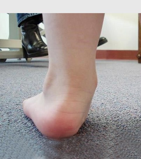 Flat Feet