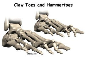 Hammertoe