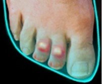 Hammertoe