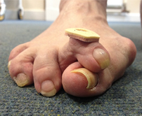 Hammertoe Treatment Sydney  Foot Deformities Treatment Sydney