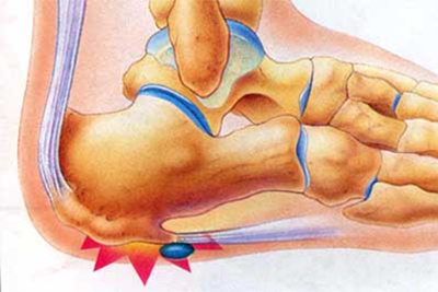 Heel Pain Diagram