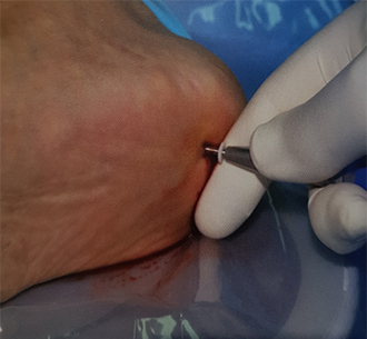 Heel Spur Pain