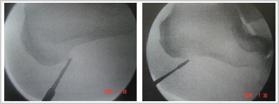 Heel Spur Pain