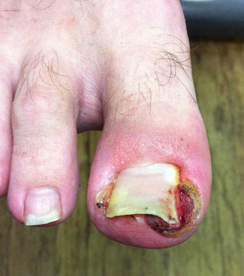 Ingrown Toe Nail