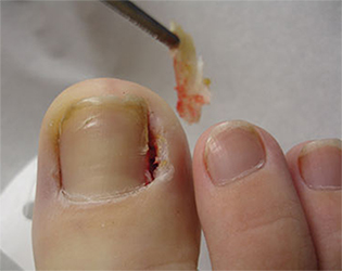 Ingrown Toe Nails