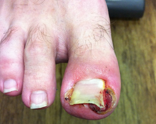 Ingrown Toe Nails