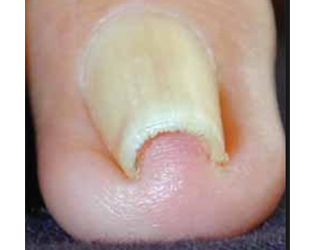 Ingrown Toe Nails