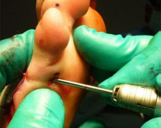 Minimally Invasive Foot Surgery (Key Hole)