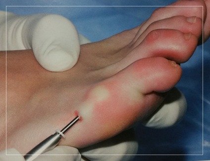 MINIMALLY INVASIVE FOOT SURGERY