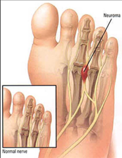 Mortons Neuroma