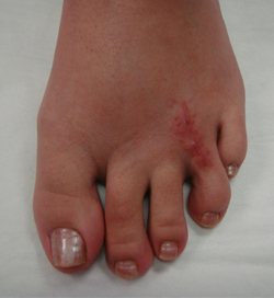 Mortons Neuroma