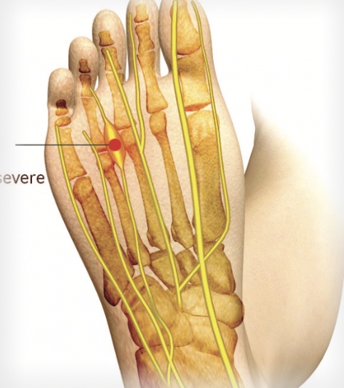 Morton's Neuroma Pain