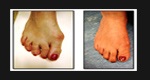 Bunion Surgery