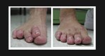 Hammer Toe