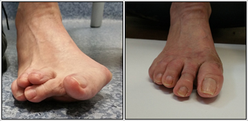 Revision Of Failed Foot Surgery