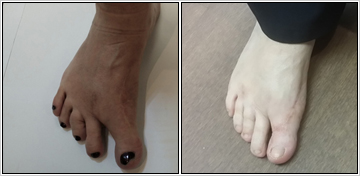 Revision Of Failed Foot Surgery