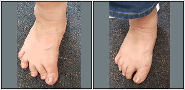 Revision Of Failed Foot Surgery