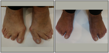 Revision Of Failed Foot Surgery