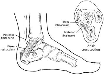 Tarsal Tunnel Syndrome