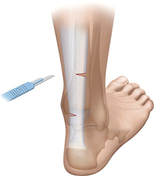 Why Foot Ligament Pain Occurs - Neuragenex